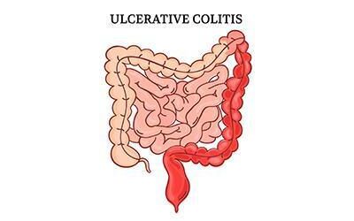 Nutrition and Ulcerative Colitis